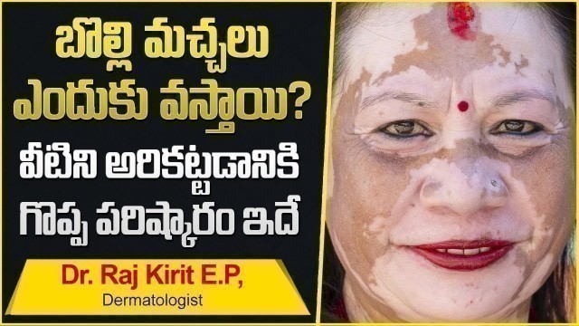 'How to cure Vitiligo | Health Tips in Telugu | Dr. Raj Kirit E.P Full Interview'