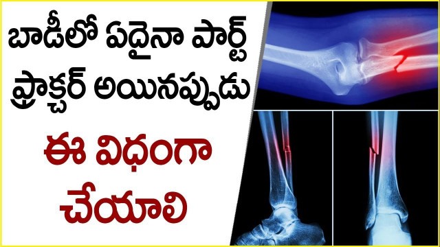'How to cure fractures at home | Health tips in telugu | Dr. Chiranjeevi | Health Treasure'